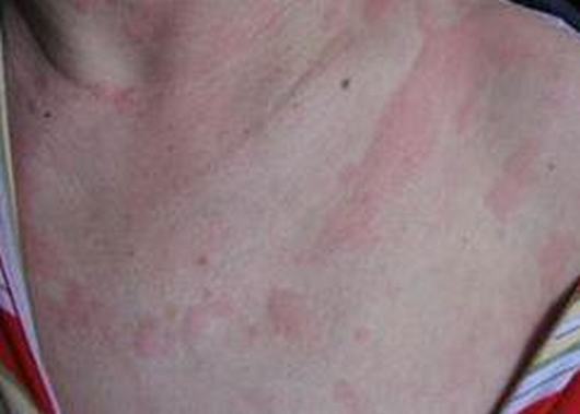关于寒冷性荨麻疹的症状表现