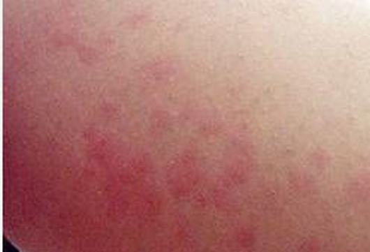 如何的治疗寒冷性荨麻疹