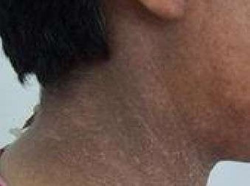 瑞尔氏黑变病的症状有哪些