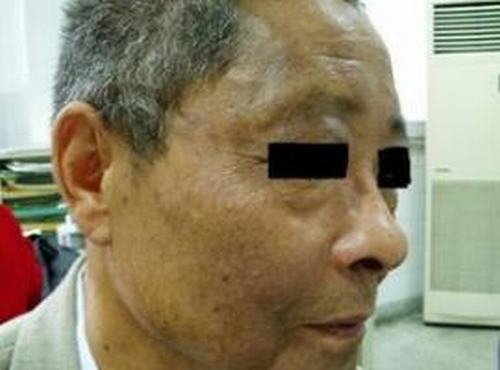 职业性黑变病的鉴别种类
