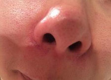 过度护肤红血丝找上门