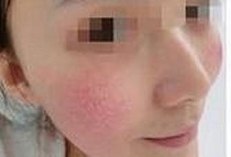 出现红血丝注意做好护理