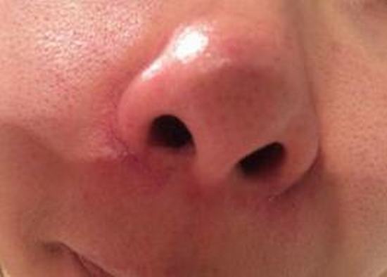 怎么样才能正确去除红血丝