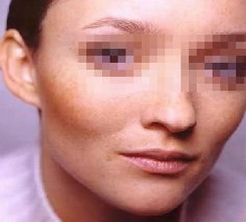 黄褐斑患者如何自我调节