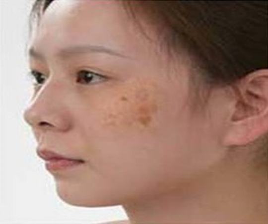 一般黄褐斑常见的病因都有什么