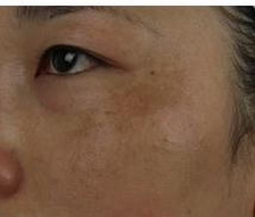 去除脸上的黄褐斑的方法