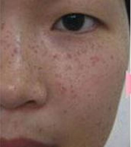 雀斑和黄褐斑的区别是什么