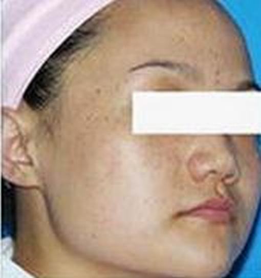 为何女性更容易患黄褐斑