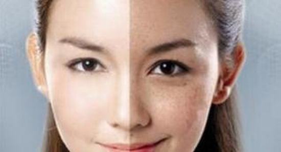 医生解释去除黄褐斑吃什么