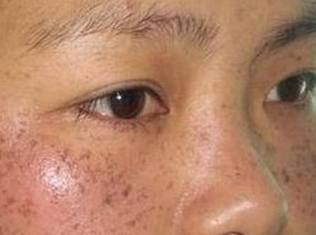 导致蝴蝶斑是如何形成的