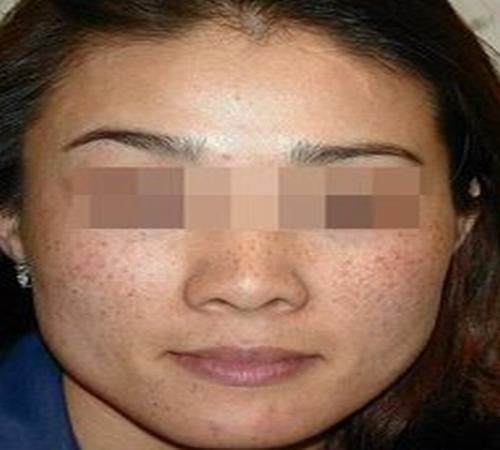 介绍几种去雀斑的方法
