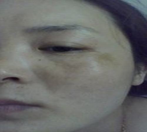 斑并非孕妇所独有