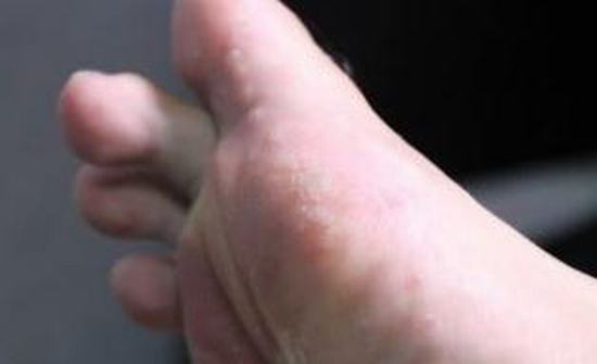 三类治脚气常规药