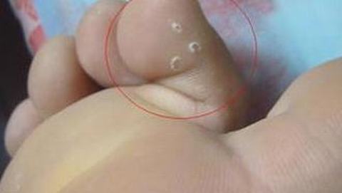 脚气病用什么药可以完全治愈呢