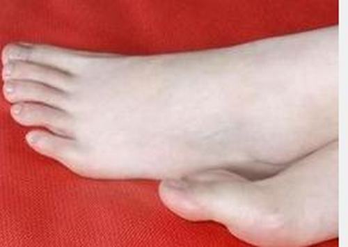 脚气如不及早的治疗会患者带来什么伤害