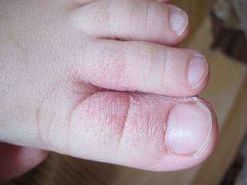 脚气的症状表现与病因