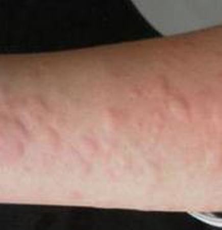 触摸性荨麻疹的病因是什么