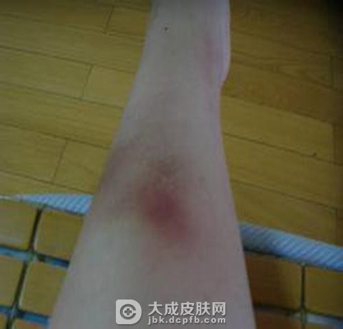 患上结节性红斑有什么后果