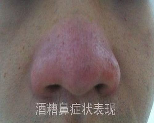 怎样治疗酒糟鼻较好