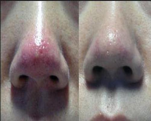 酒糟鼻治疗偏方
