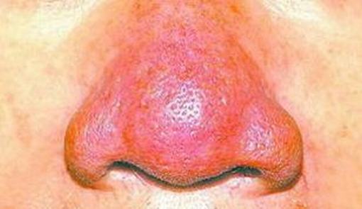 丘疹期的酒糟鼻的症状是什么
