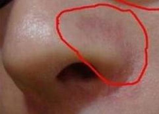 什么食物容易刺激到酒糟鼻