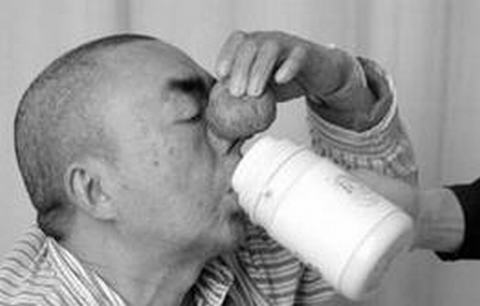 酒糟鼻是毛囊虫感染引起的