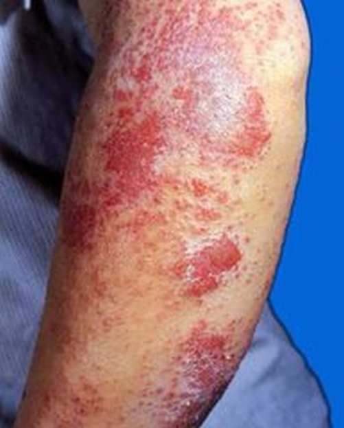 预防急性湿疹要注意哪些呢？