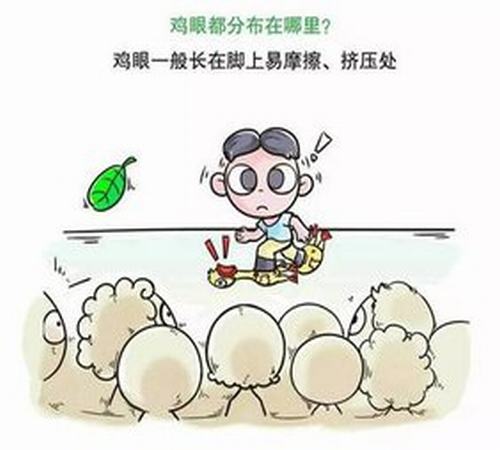 鸡眼的症状介绍