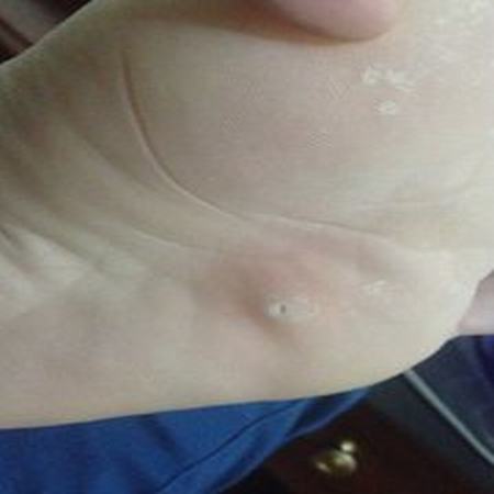 鸡眼有什么症状呢