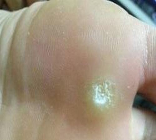 脚上鸡眼的症状有哪些