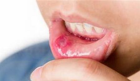 口腔白斑的临床表现是什么