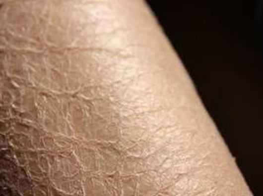 毛囊性鱼鳞病的皮肤护理