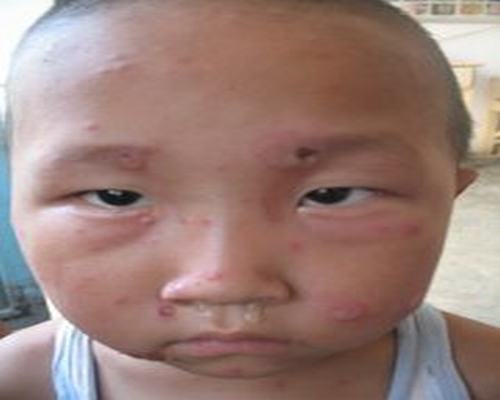 识别脓疱疮宝妈别再束手无策