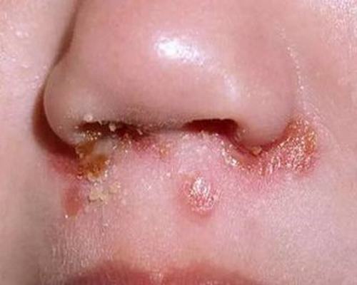 脓疱疮都会有哪些的特点