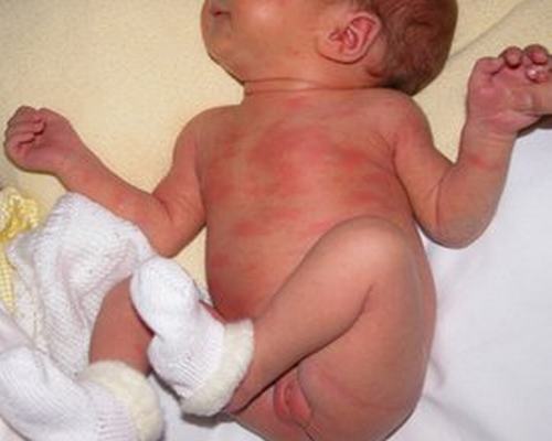 专家对新生儿脓疱疮的皮肤特点的相关介绍