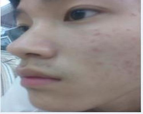 导致青春痘的四大原因