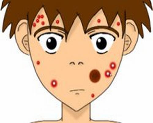 治疗青春痘的误区你犯了几条