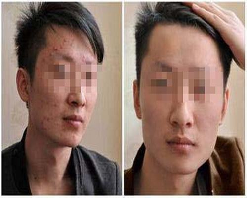 治疗青春痘有哪些注意事项呢