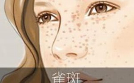 对于雀斑您了解多少呢