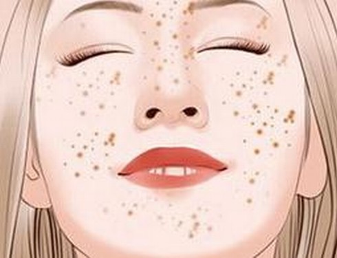 雀斑的护理注意什么