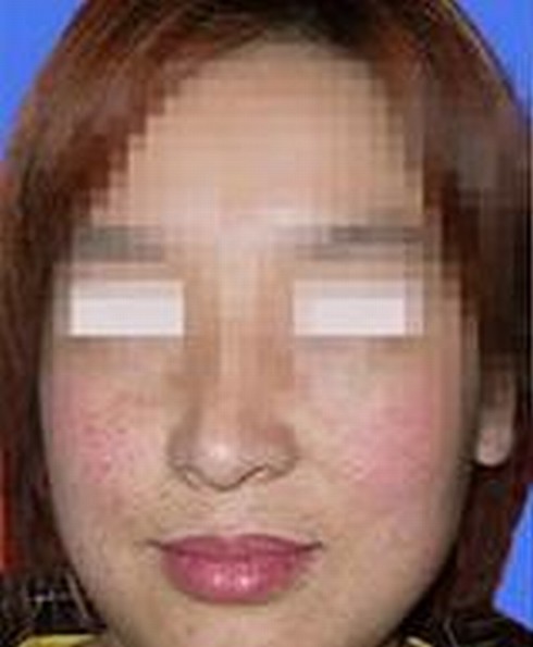 雀斑的原因是什么