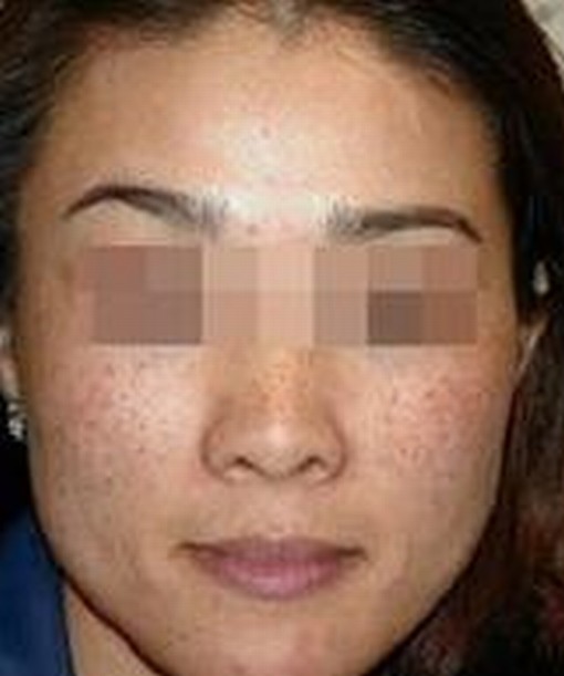 遗传性雀斑的症状特点有什么