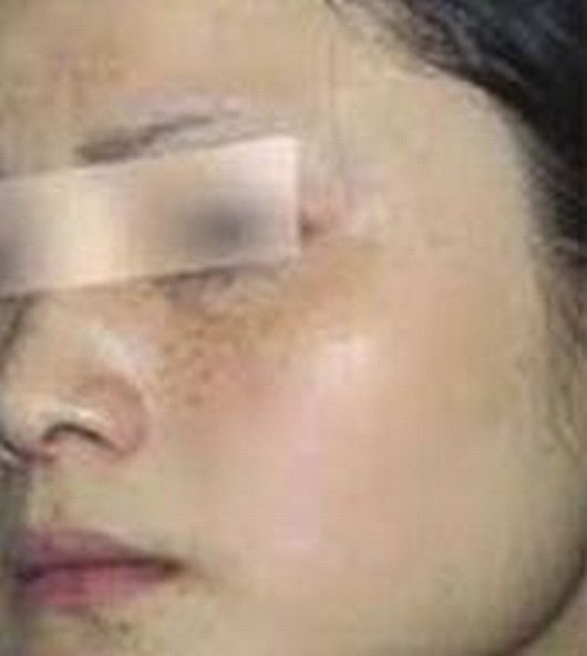 怎么去雀斑疗效很好呢