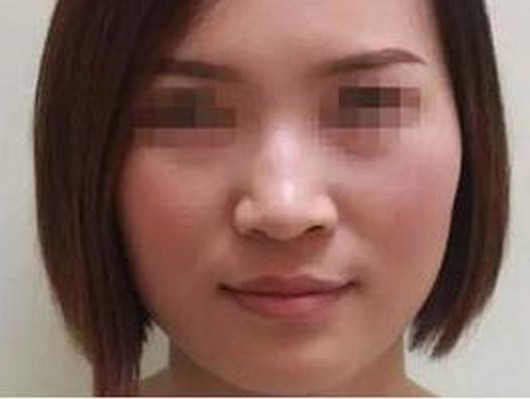 治疗雀斑应该注意什么是什么