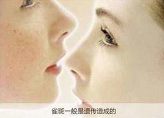 专家就给大家详解雀斑