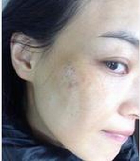 对遗传性雀斑的表现有哪些