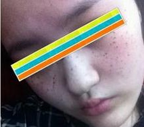 女性如何护理雀斑有效