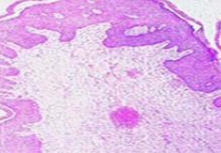 什么是黏液软纤维肉瘤