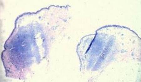 专家解析外阴软纤维瘤的病因表现